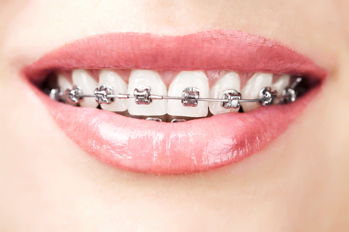 DAMON BRACES Best Dentist in Bangalore, Sarjapur Road