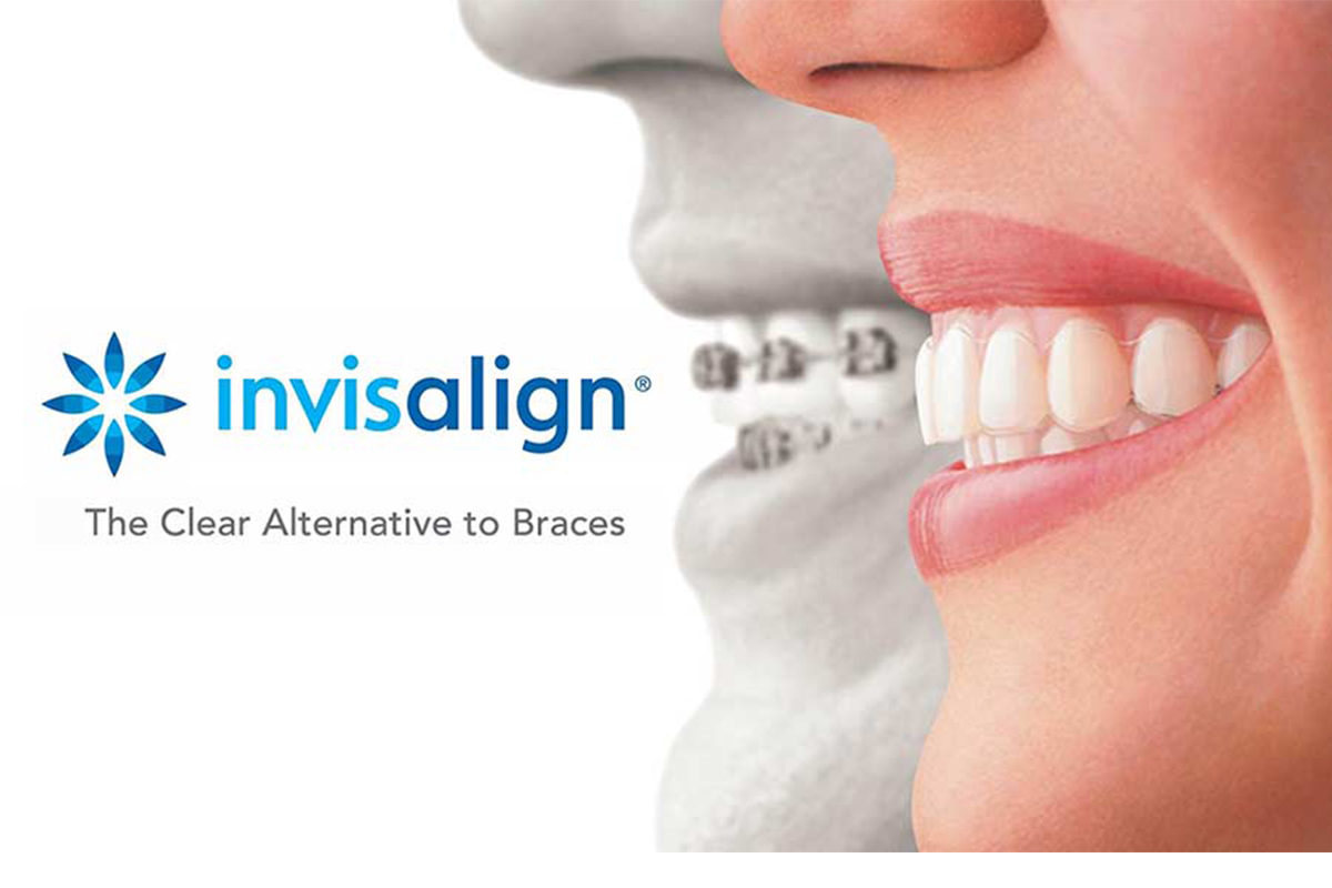 INVISALIGN CLEAR ALIGNERS