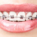 Customised-Orthodontic-treatments