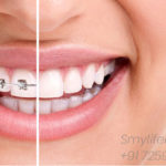best-orthodontics-in-bangalore