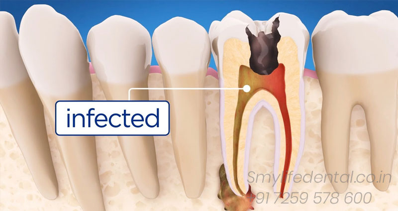 Best Root Canal Treatment